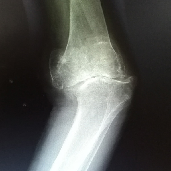 膝關節(jié)內翻